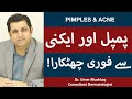 How To Remove Pimples Overnight Acne Treatment Pimple Khatam Karne Ka Tarika