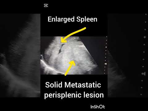 Ultrasound showing splenomegaly!Solid Metastatic lesion!#ultrasoundmadeeasy86#radiology#ultrasound