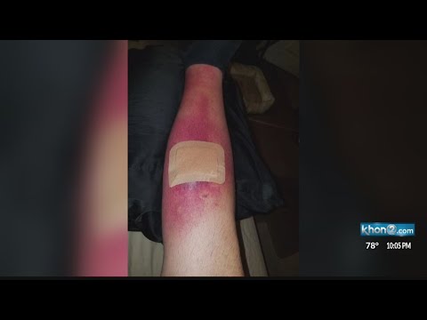 Spider bite lands Kapolei man in hospital