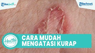 Cara Mengatasi dan Mencegah Jamur Ringworm atau Kurap, Olesi Salep dan Mengeringkan Kulit