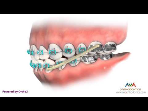 Orthodontics Treatment for Underbite or Crossbite - Rubber Bands
