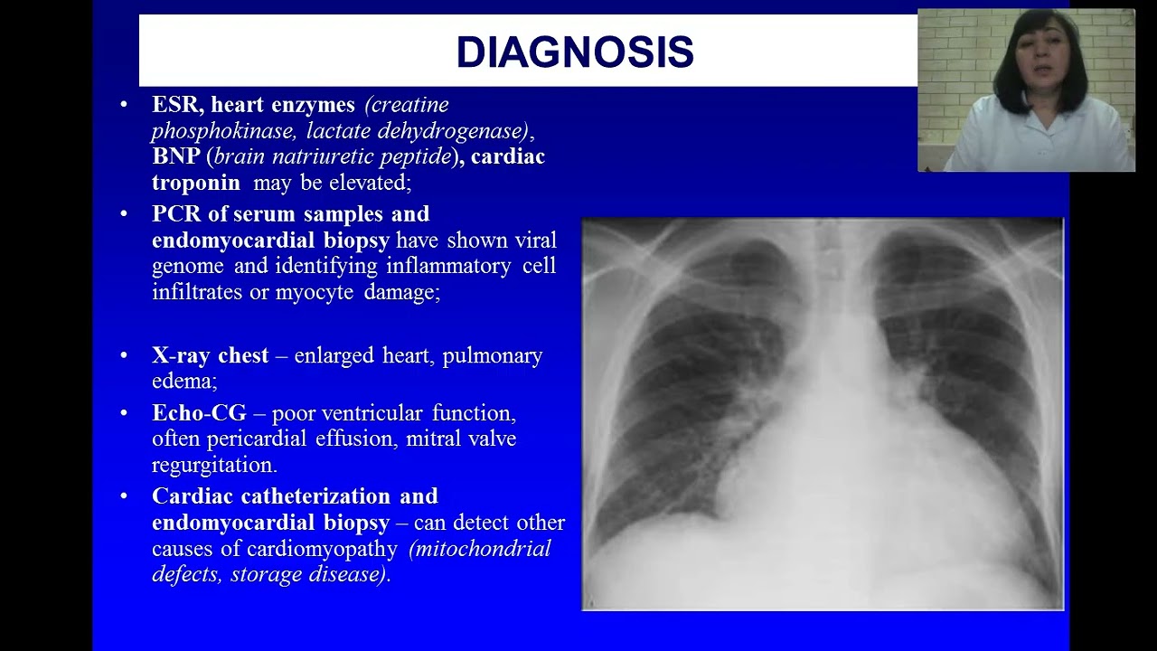 Nonrheumatic carditis in children. Cardiomyopathy