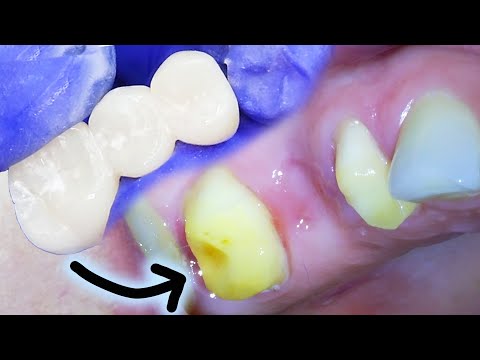 Full Dental Bridge Procedure Step by Step Including the Extraction on a Badly Infected Molar