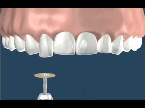 Dentistry Recontouring Teeth 1