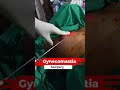 Gynecomastia Surgery Gynecomastia Surgery Cost Short Short Shorts Share