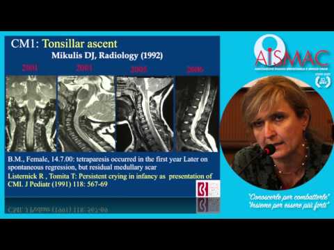 Mal di regione sul lato destro della schiena Perdita di capelli e sintomi di osteocondrosi cervicale