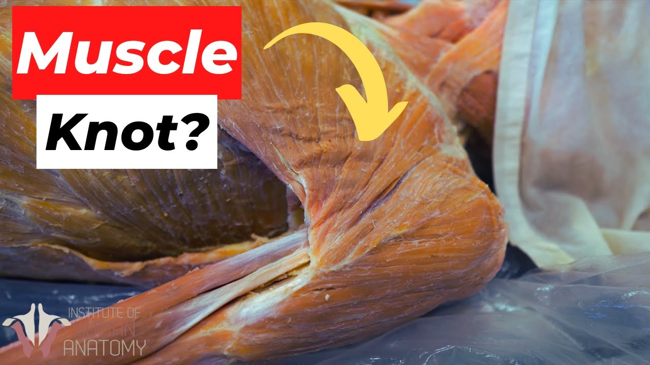 What do muscle knots look like? Wiki REF