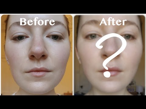 My Face After 2 Months Of V-Shape Face Massage - Did It Work?