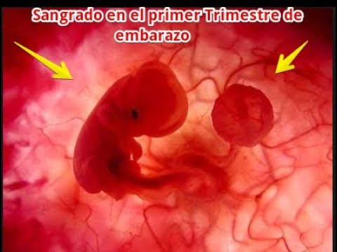 Dolor De Espalda Y Sangrado Durante El Embarazo Código Icd