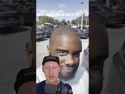 What do YOU think of this hair transplant result?