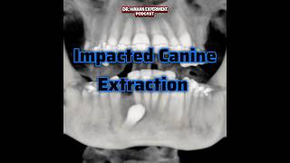 Impacted Canine Extraction
