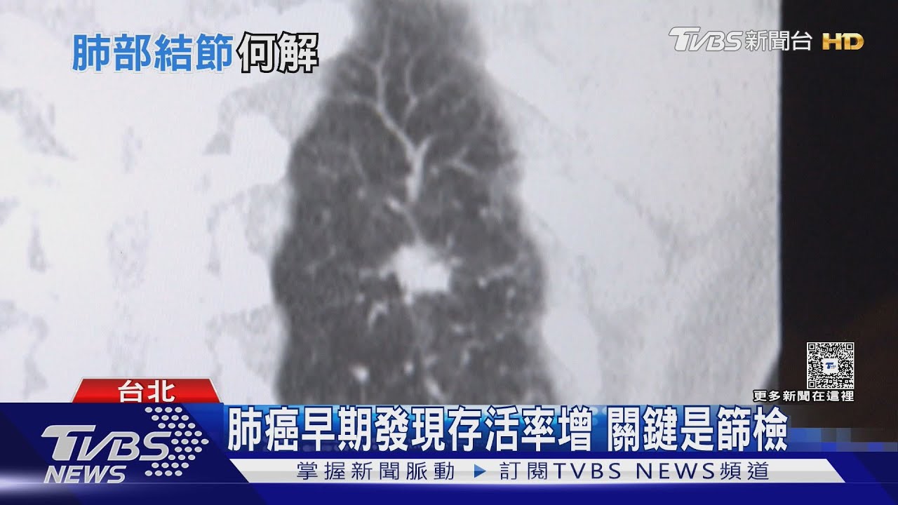 電腦斷層揪肺結節!醫師示警:不少人手術白挨刀 關鍵是「這原因」!
