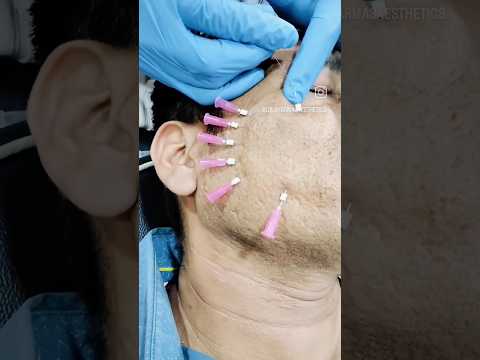 scar treatment (Acne scarring) Thread.