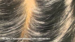 What Lice And Their Eggs Look Like