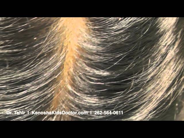 What Lice And Their Eggs Look Like Lice Kansas City Comic Con