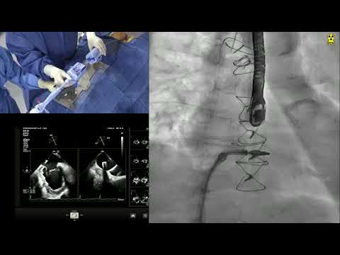 LIVE CASE 4 - FUNCTIONAL MR TEER