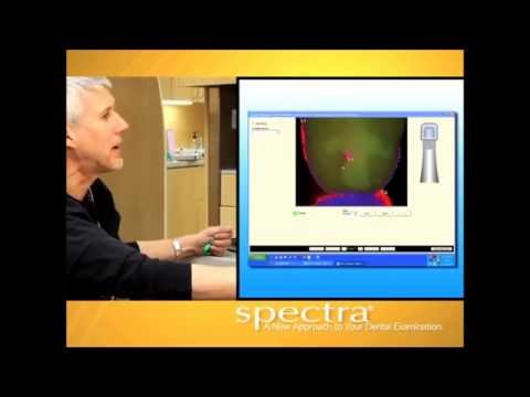 CamX Spectra Caries Detection Aid Patient Education Video