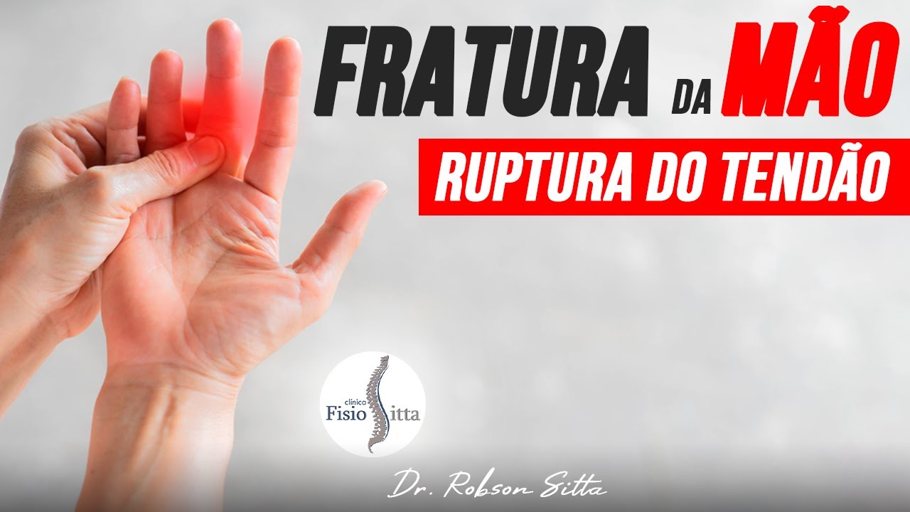 RUPTURA TENDÃO EXTENSOR e FRATURA da FALANGE DEDO da MÃO TRATAMENTO - Fisioterapia Dr. Robson Sitta