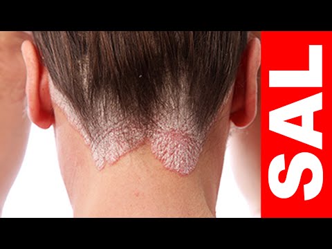 La psoriasis los medios públicos del tratamiento las revocaciones La medicina contra la eccema sin hormonas