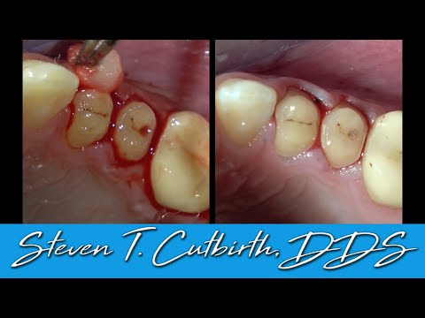 Stopping Gingival Bleeding