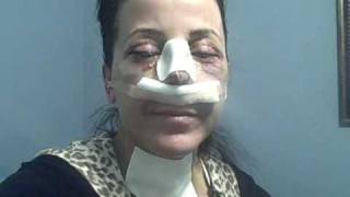 Facial Plastic Surgery: Recovery Day 5