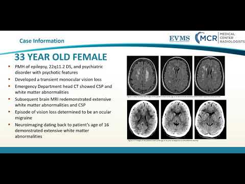 Thumbnail image of video presentation for Neuroimaging Findings in a Patient with 22q11.2 Deletion Syndrome DiGeorge Syndrome