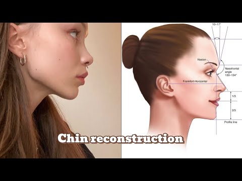 Chin reconstruction (Forward pulled fully grown chin  Subliminal )