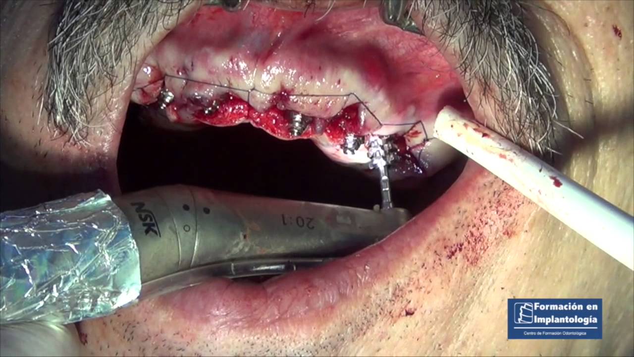 Implantes en toda la boca dientes inmediatos superior e inferior Electrosoldadura