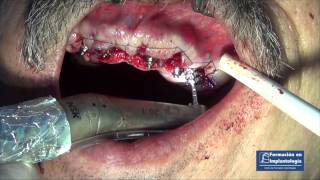 Implantes en toda la boca dientes inmediatos superior e inferior  Electrosoldadura