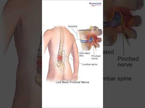 Spine Disc herniation treatment without surgery possible ? बिना सर्जरी स्पाइन स्लिप डिस्क इलाज संभव?