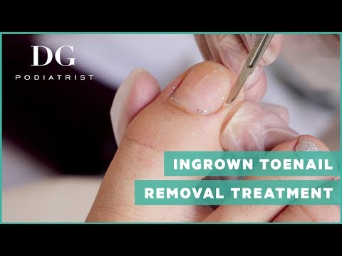 Ingrown toenail removal treatment