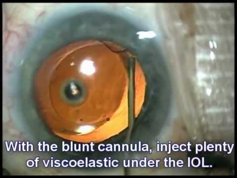 Chirurgie de la cataracte - implant intraoculaire