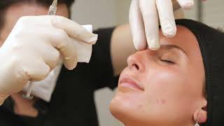 Correction of the nose bump with filler - non-surgical rhinoplasty