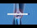 How to Tell if a Knee Injury is Serious - Yale Medicine Explains