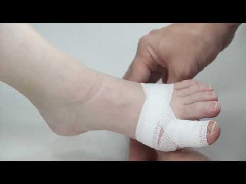 Toe Bandaging Principles and Tips