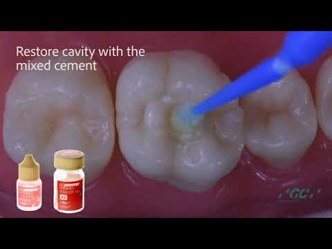 Small Cavity Restoration GL HYBRID with G Coat Plus