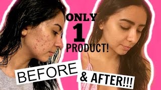HOW I CLEARED MY ACNE IN 2 WEEKS!! BEFORE AND AFTER PICS!