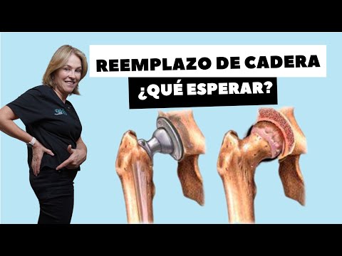 REEMPLAZO DE CADERA ¿QUÉ ESPERAR?
