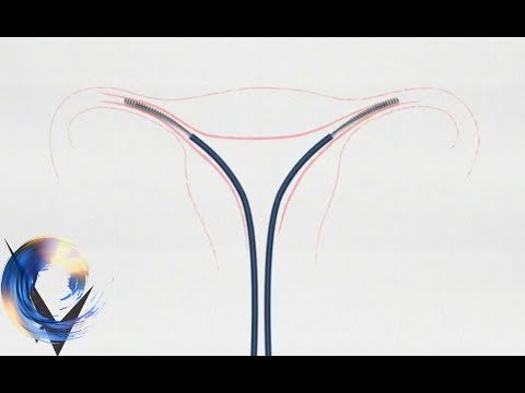 Women needing hysterectomies to remove Essure sterilisation implant   - BBC News