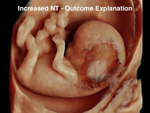 Increased Nuchal Translucency
