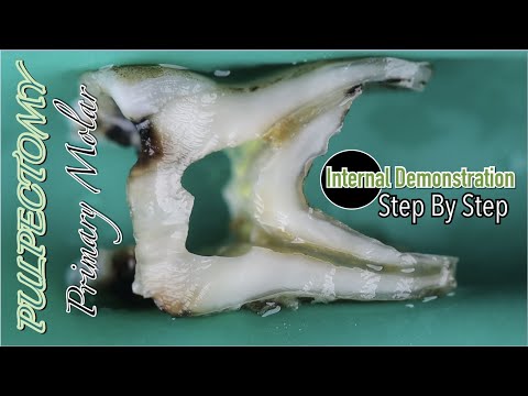 Pulpectomy in Primary Mandibular Molar | Internal Demonstration | Step By Step