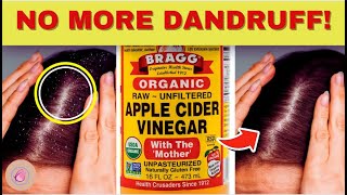 10 NATURAL WAYS YOU CAN DESTROY DANDRUFF FAST