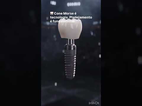 🦷 Cone Morse é tecnologia. Planejamento é fundamental!