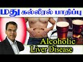 Alcoholic Liver Disease மது கல்லீரல்பாதிப்பு Liver Failure Gas