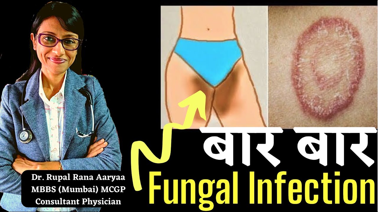 Private Parts 🤫 mein baar baar FUNGAL INFECTION hota hai 😞,TREATMENT of RECURRENT FUNGAL INFECTION