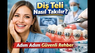 Diş Teli Nasıl Takılır? Adım Adım Güvenli Rehber