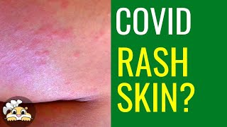 How to get rid of Covid rash skin naturally - 3 simple steps