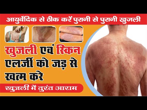 स्किन इन्फेक्शन की समस्या | Skin Infection Problems | RM Ayurved | 📞 9411632933