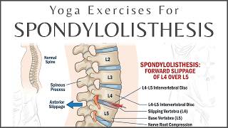 Fix Back Pain from Spondylolisthesis | Gentle Yoga Stretch at Home