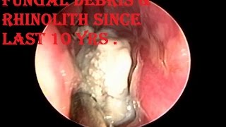 Suffering from Nose Blockage , Post Nasal Discharge  since last 10 yrs - Got relief after Procedure